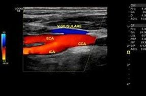 Studio color doppler TSA (tronchi sovra aortici) immagine