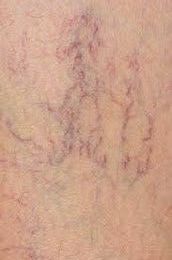 capillari