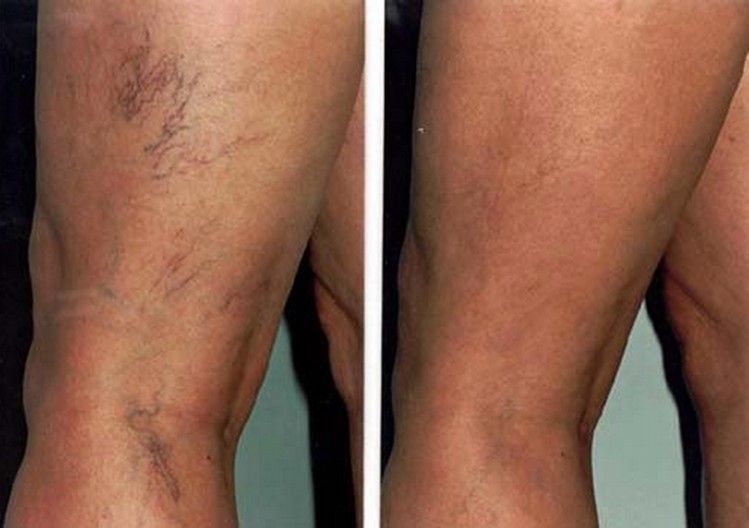 scleroterapia prima e dopo