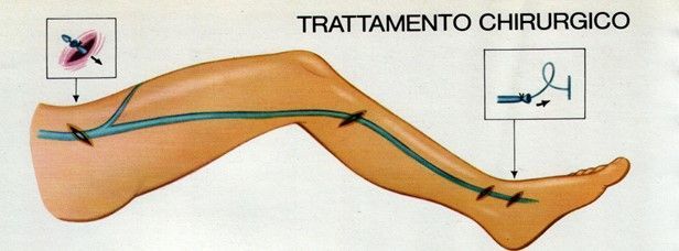 Terapia chirurgica Crossectomia stripping trattamento chirurgico