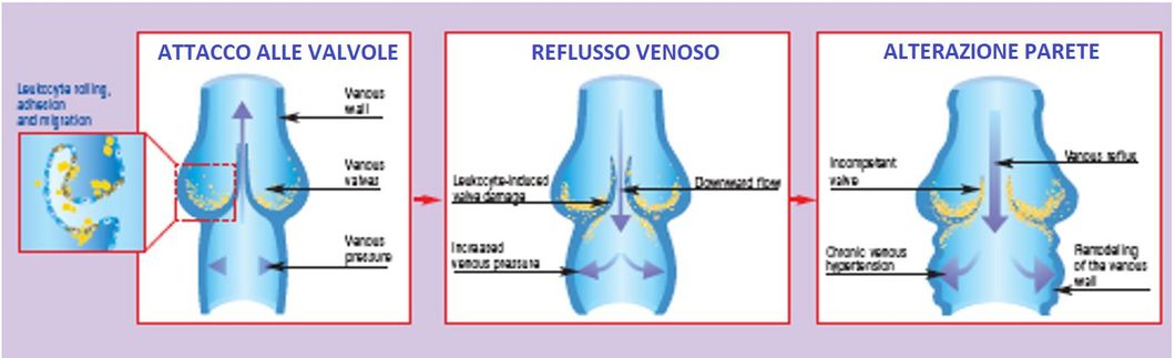 schema circolo vizioso varici