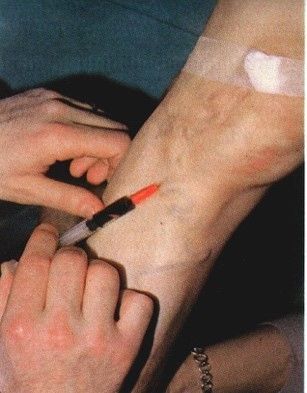 terapia per varici essenziali arti inferiori