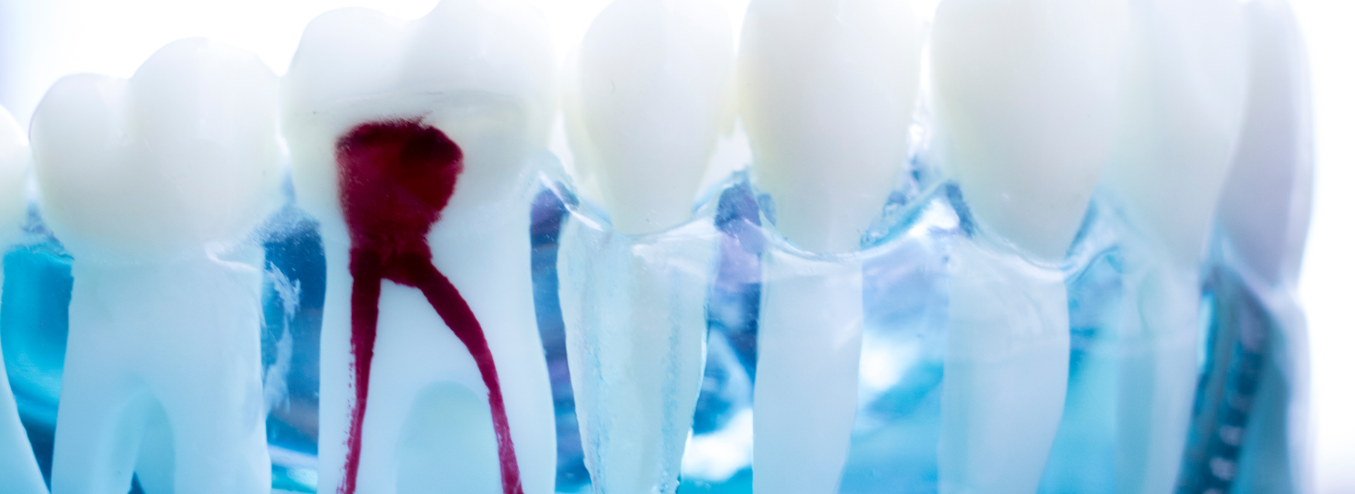 Root Canal