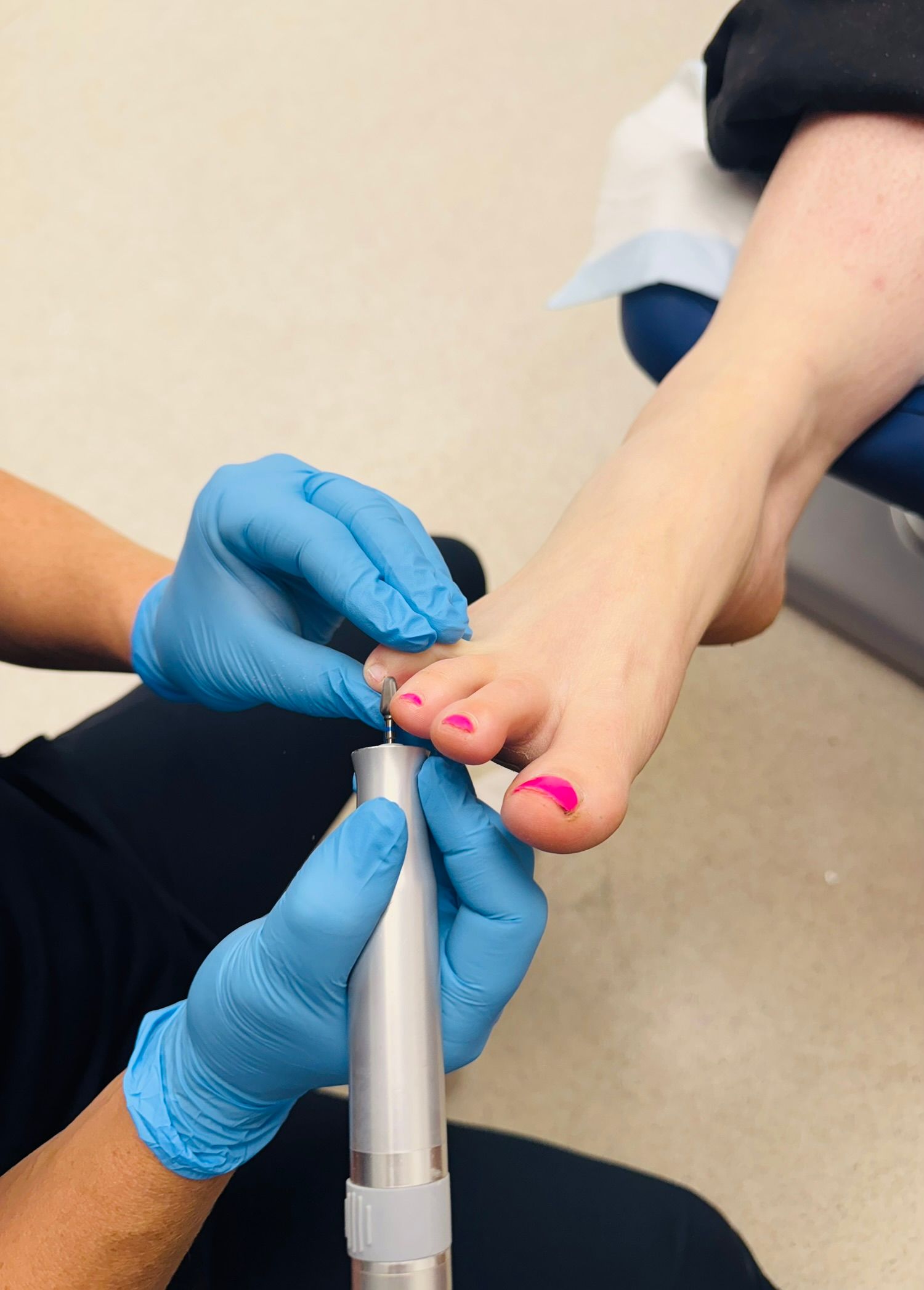 A person's foot being treated by a healthcare professional, who is wearing gloves and using a tool on a toenail. — Alice Springs Podiatry in Ciccone, NT