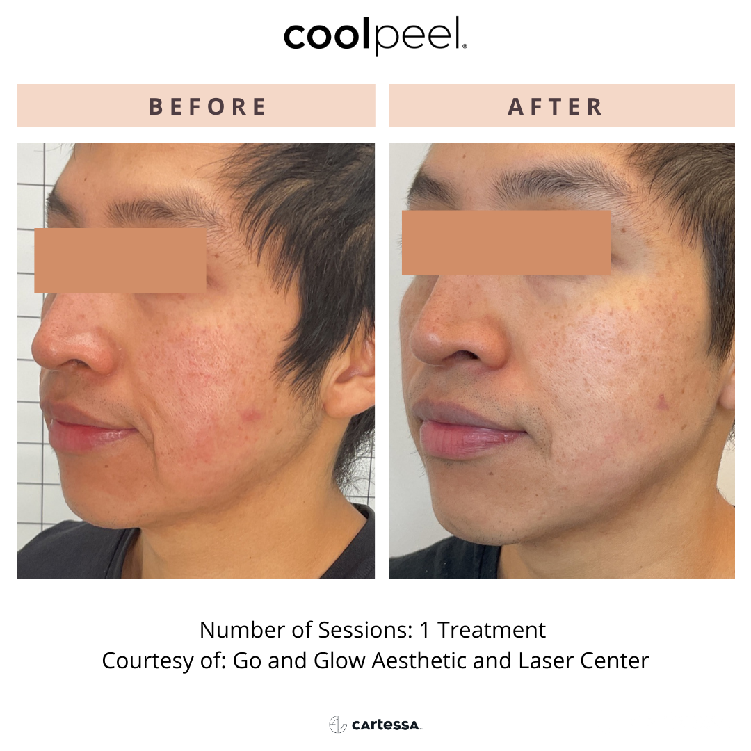 Side-by-side comparison of a person's face before and after a CoolPeel treatment, showing improved skin texture.