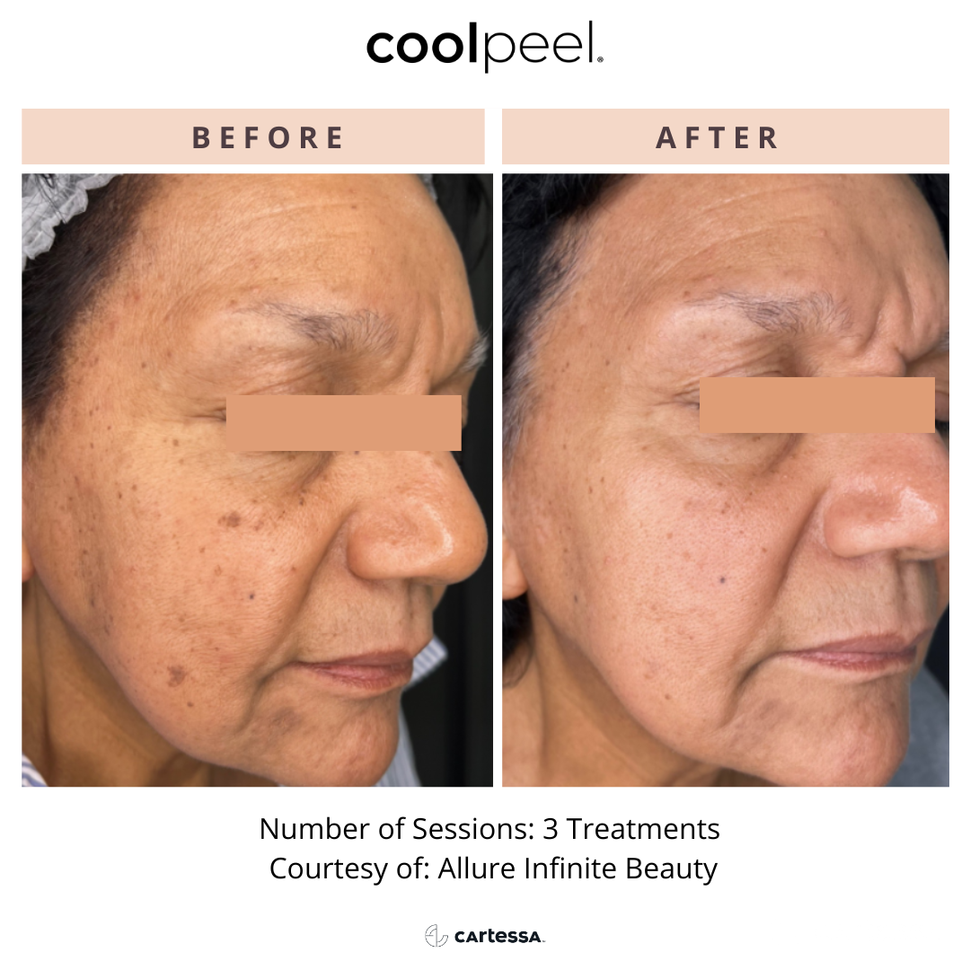 Side-by-side comparison of a woman's face before and after CoolPeel treatments;
