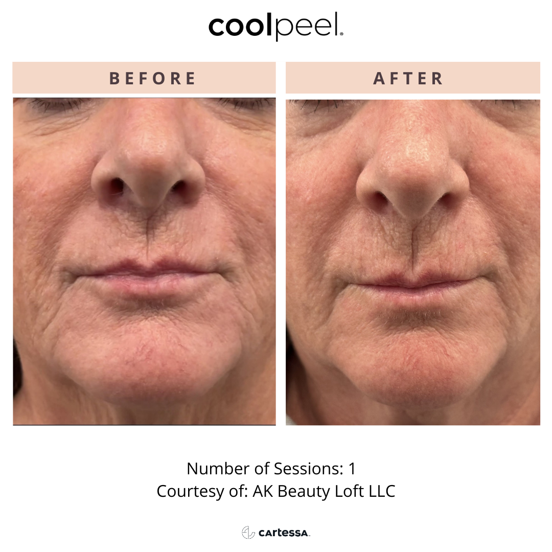 Side-by-side comparison: face before and after CoolPeel laser treatment. Lines around the mouth are reduced.