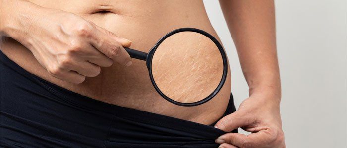 Person using magnifying glass to examine stretch marks on abdomen.