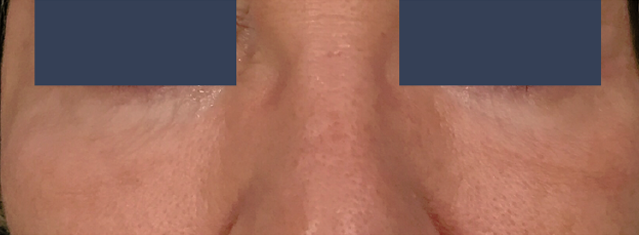 patient 1 after