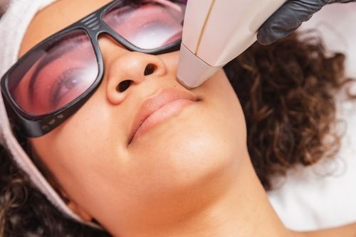 Woman receiving laser hair removal treatment on upper lip, wearing protective eyewear.