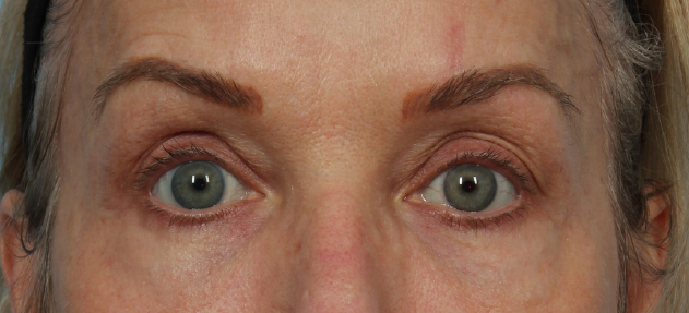 patient 1 after