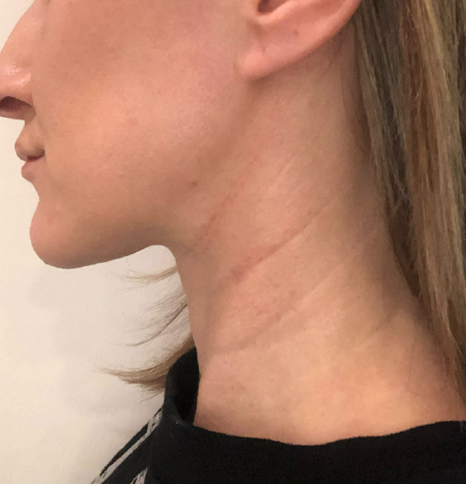 patient 1 after