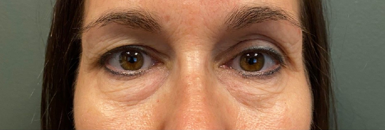 patient 1 before