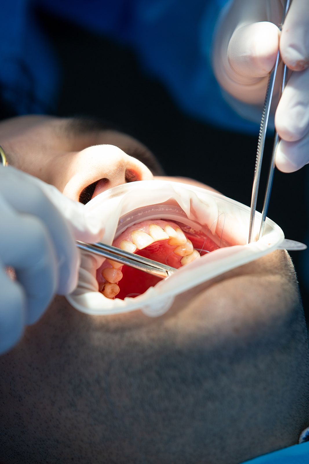 Boca de una persona abierta durante un procedimiento dental; dientes expuestos, rodeados por un retractor bucal y herramientas en uso.