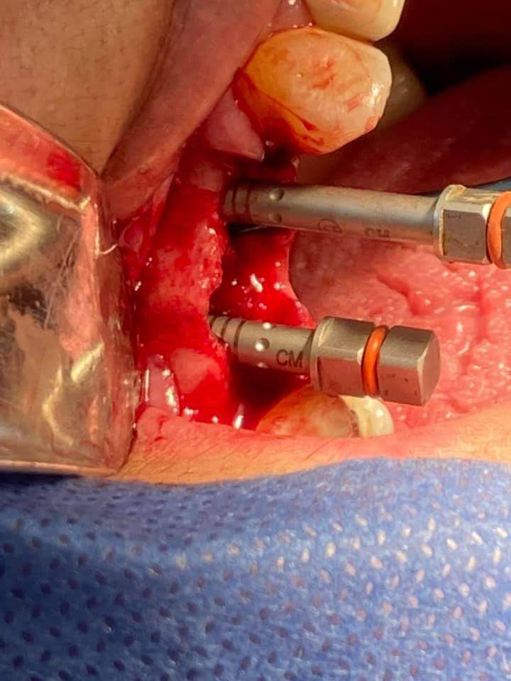 Cirugía dental con herramientas de perforación en cavidad oral ensangrentada.