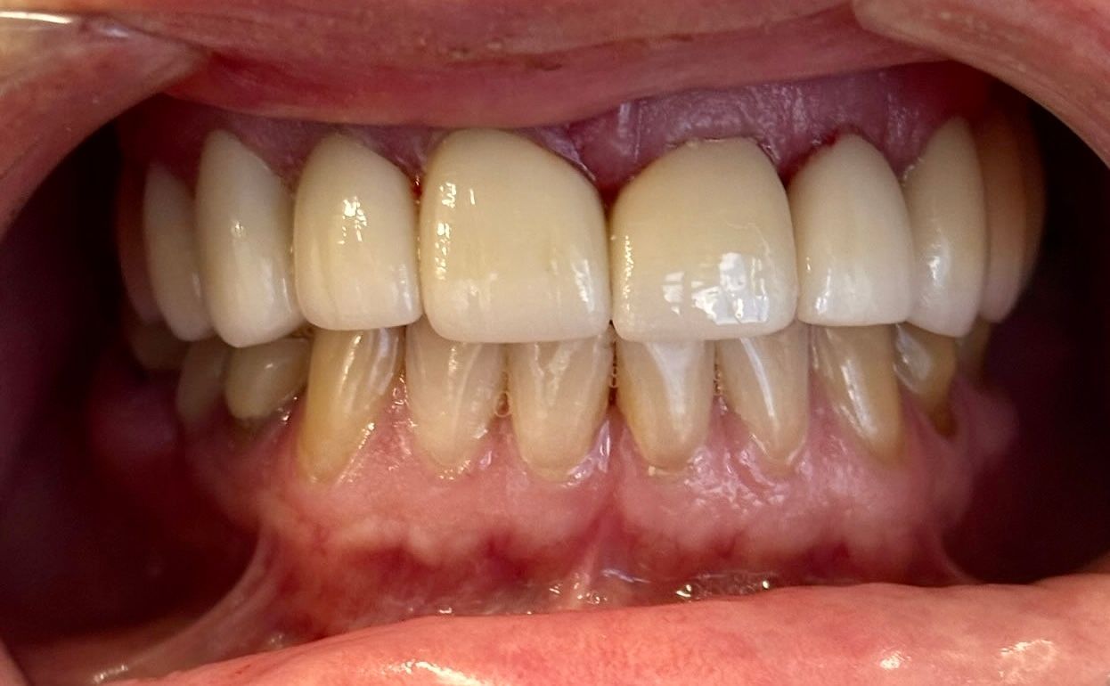 Close-up of teeth and gums with visible yellow staining along the lower front teeth.