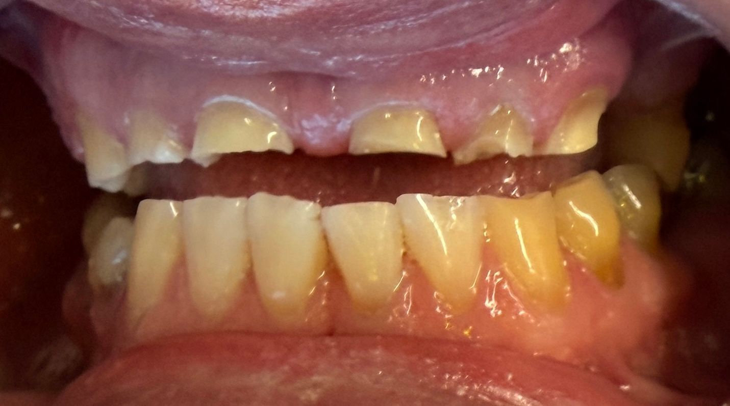 Close-up of teeth with severe plaque buildup and yellow discoloration on upper and lower front teeth