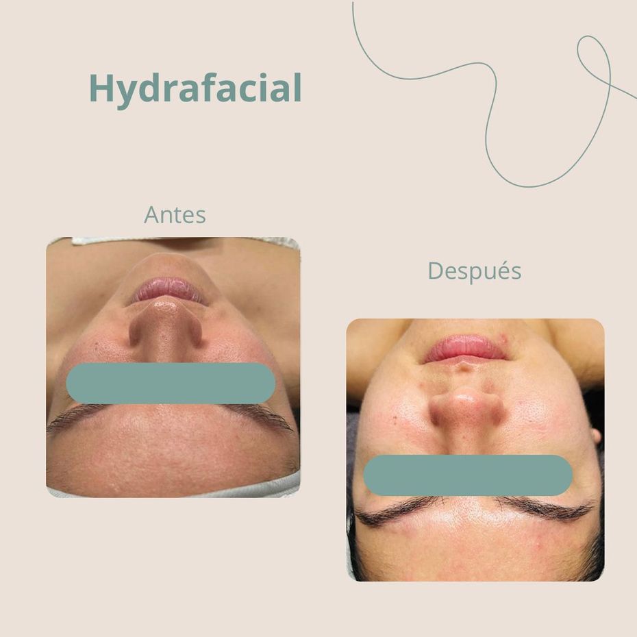Beauty Room en Guadalajara Antes y despues Hydrafacial