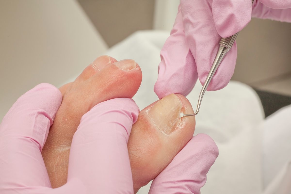 How to identify verrucae