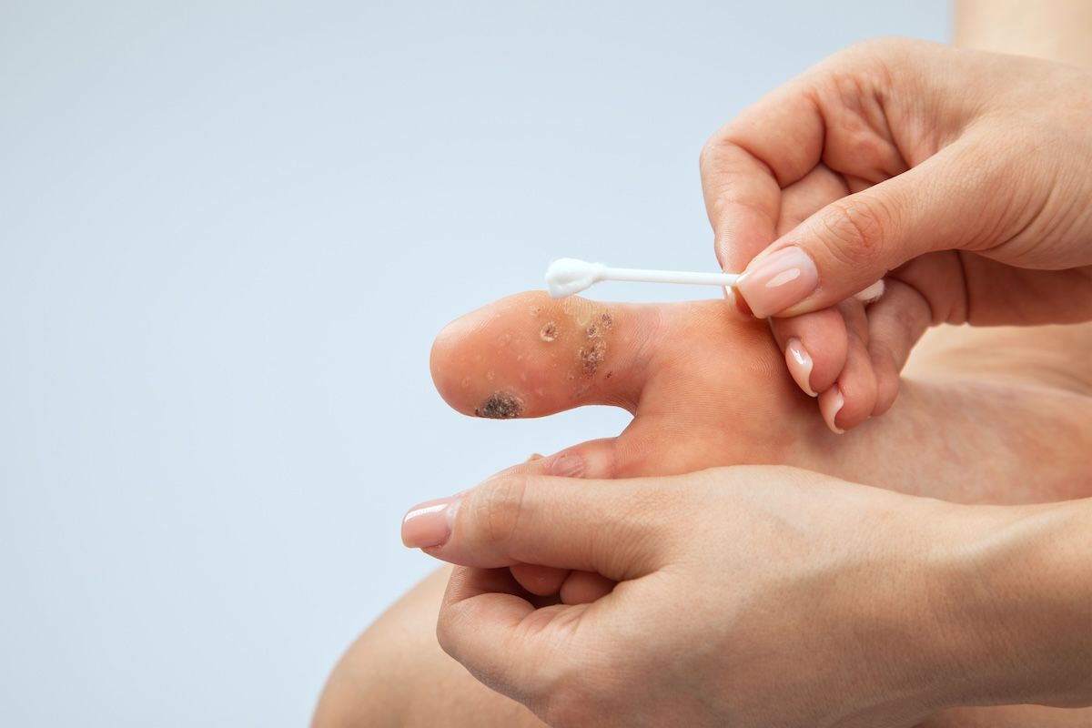 Verruca Treatment: Options, Costs and Swift Microwave Therapy