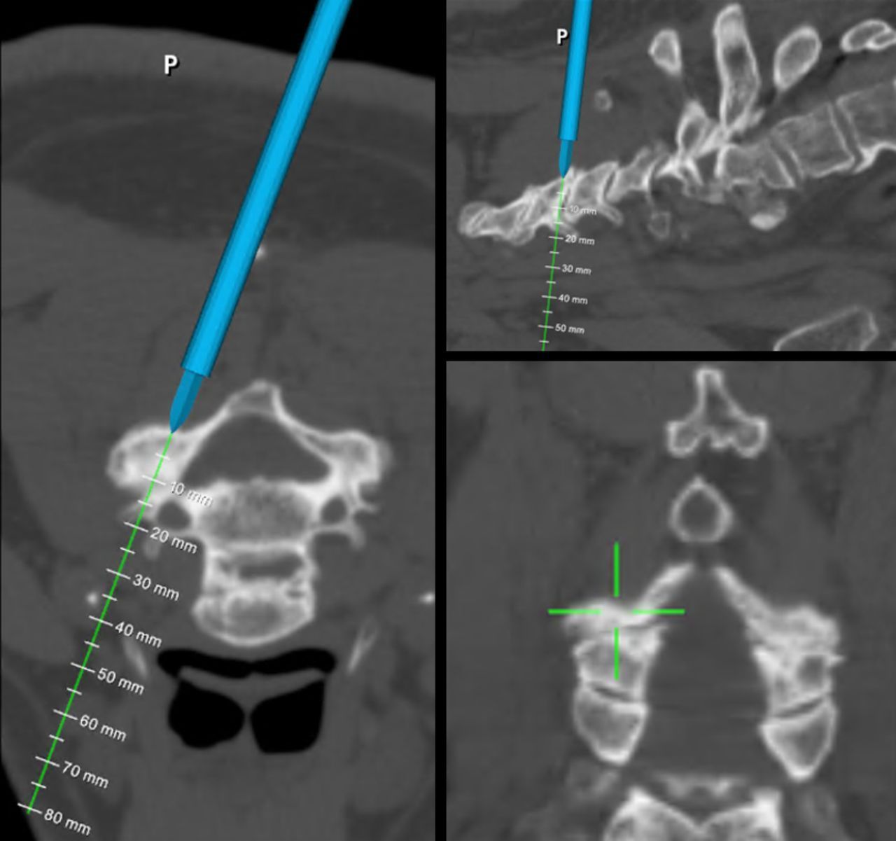 CT scan with blue and green measurement lines marking the cervical spine on three views.