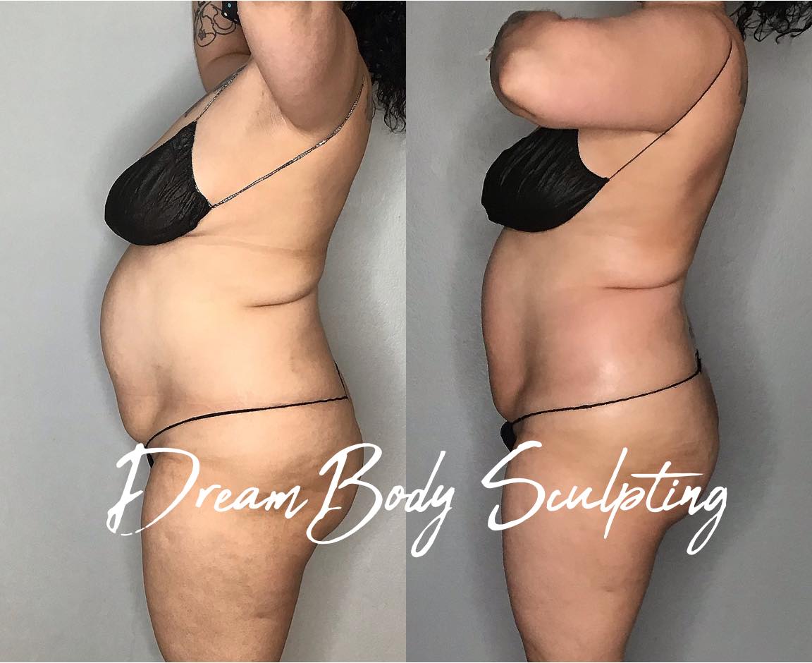 Before and after body sculpting photos. Side profile of a person in a bikini, showing abdomen changes.