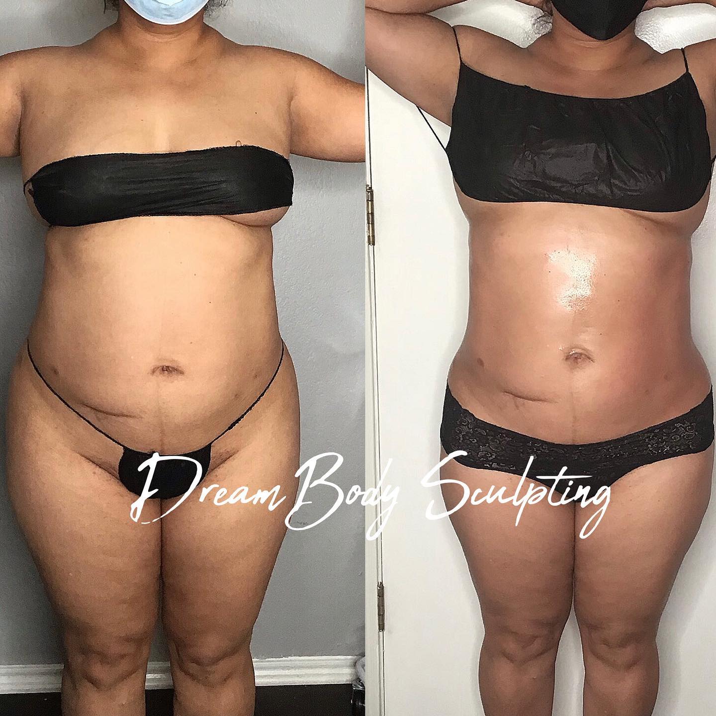 Side-by-side comparison of a person's torso before and after body sculpting. The after photo shows a more defined waist.