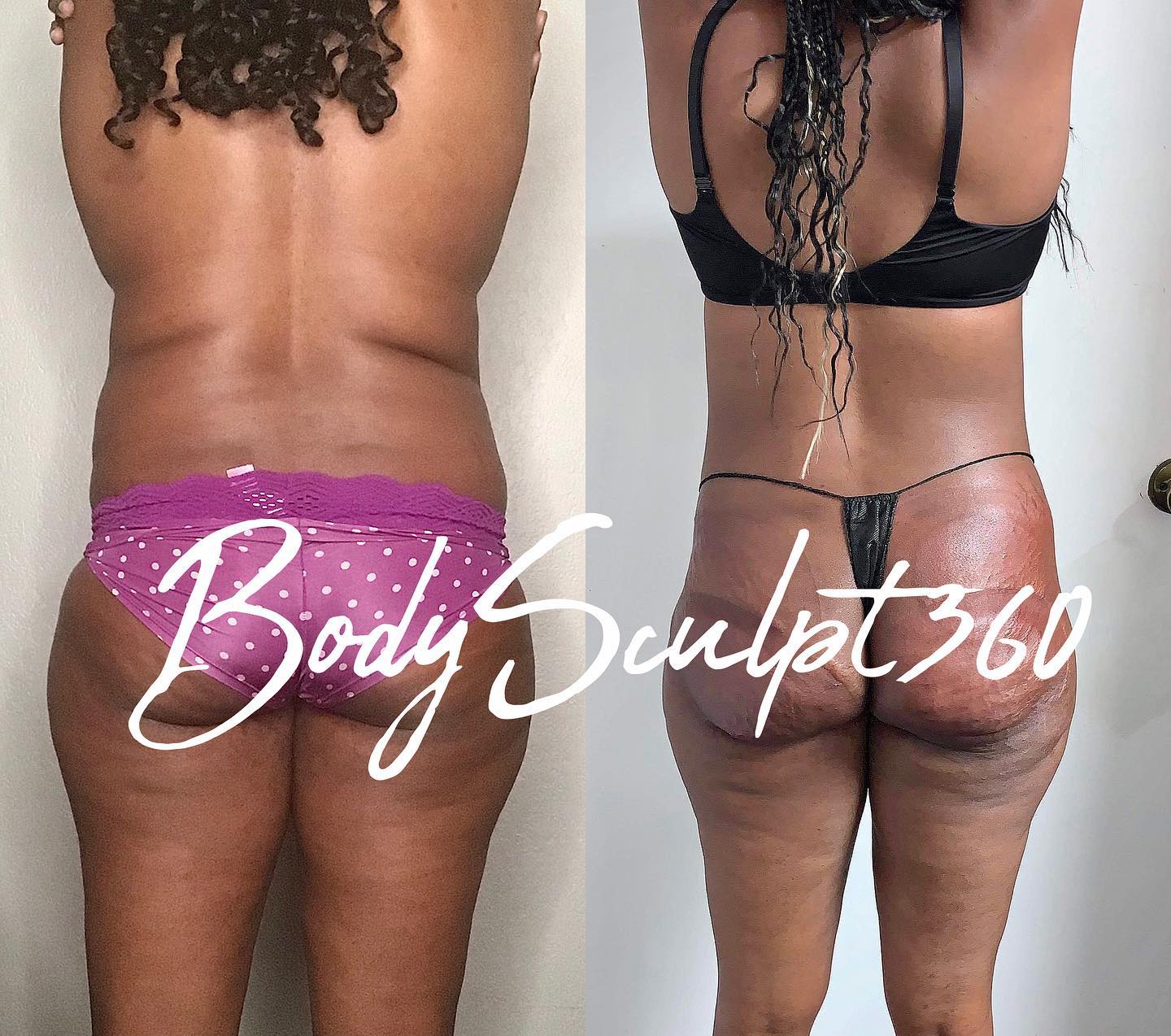 Before and after body sculpting photos of a person, showcasing changes to their posterior and thighs.