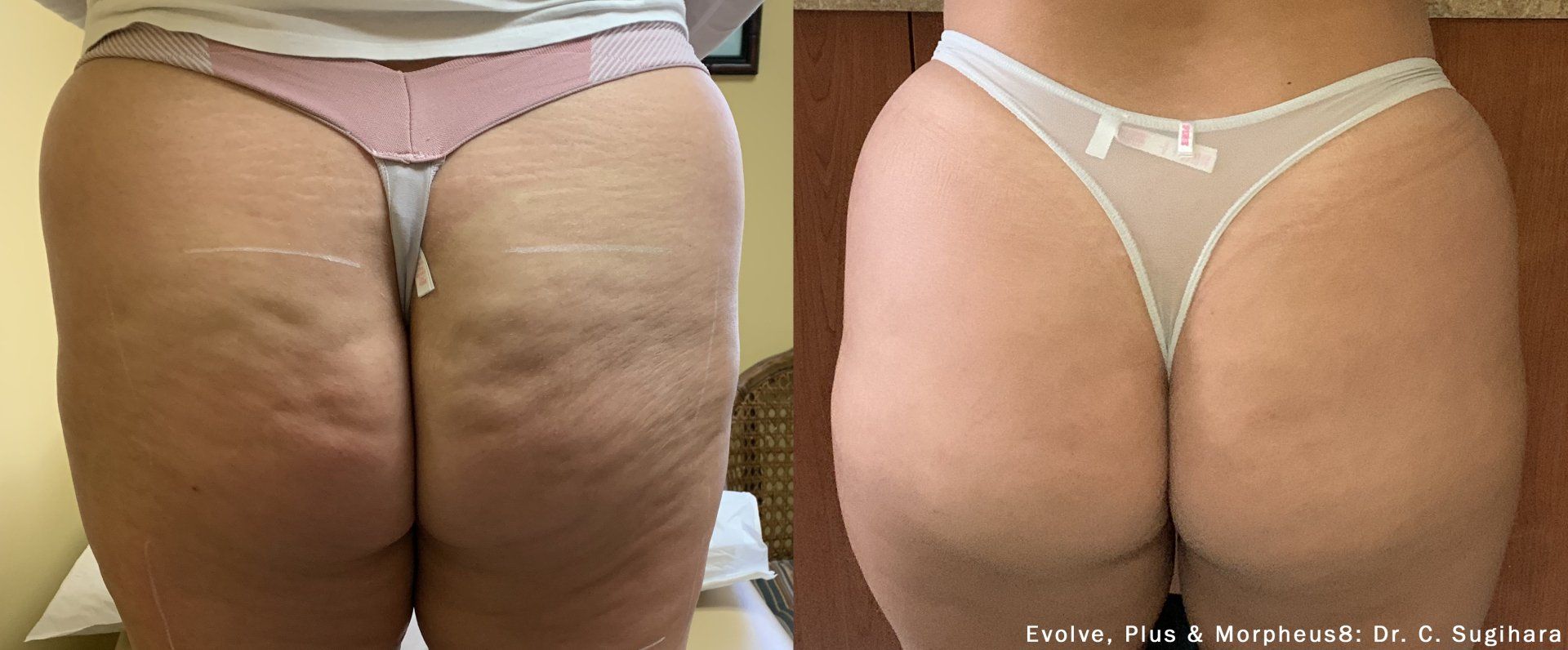Side-by-side view of a person's buttocks. Before: skin with cellulite. After: smoother skin.