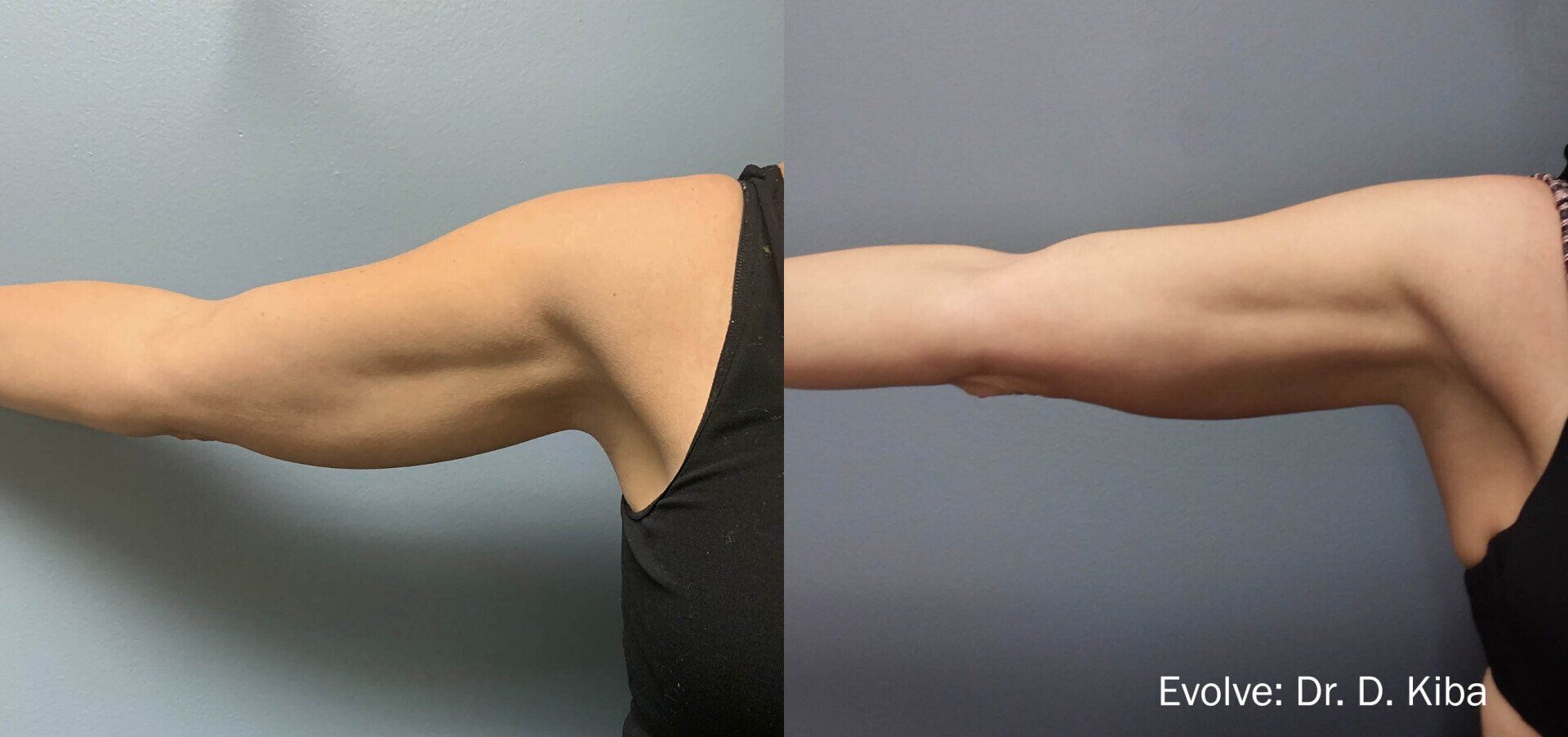 Before and after arms; tone, definition, and reduced sagging are visible.