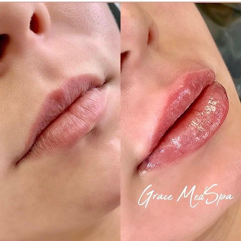 Before and after comparison of lips; before: pale, thin lips; after: full, pink, glossy lips.