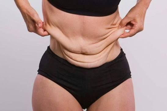 Loose abdominal skin being evaluated for a personalized skin-tightening treatment