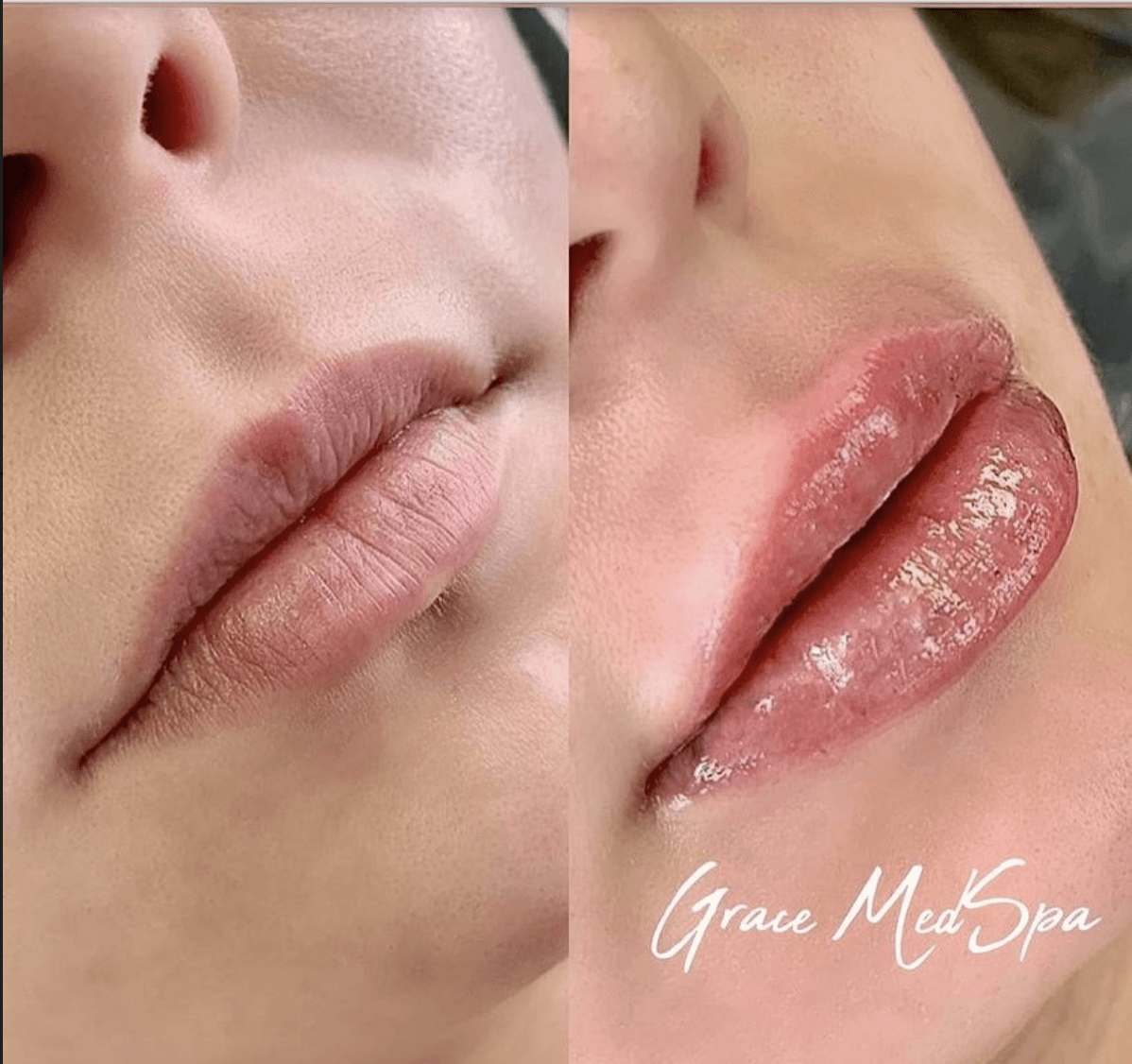 Before and after of lip augmentation. Left: thin lips. Right: fuller, enhanced lips with a glossy finish.