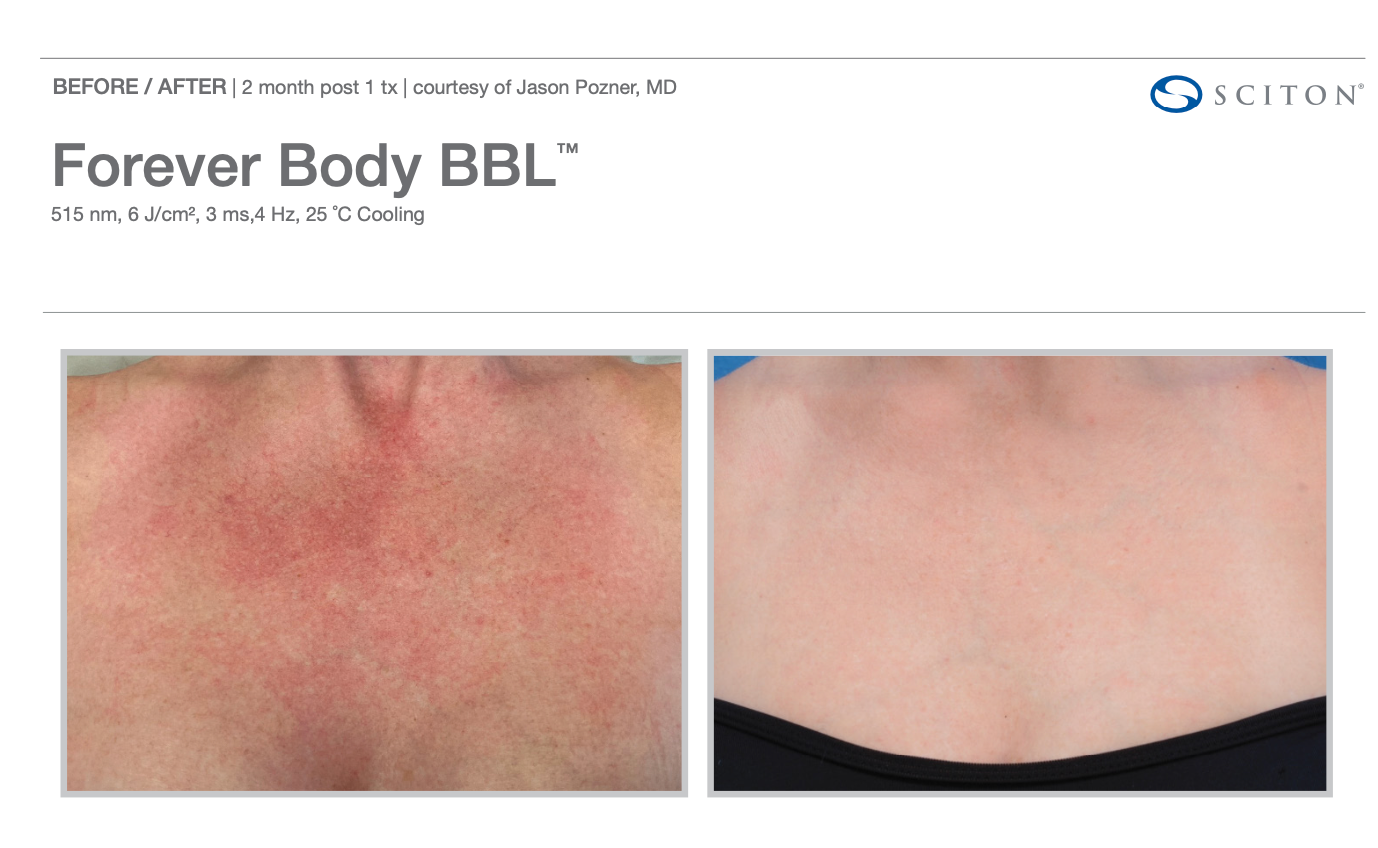 Before and after photo of a body part. Redness is reduced after treatment.
