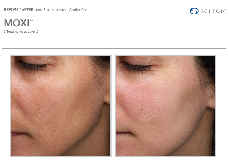 Before/after comparison of a face. The left side shows skin with spots. The right shows smoother, clearer skin.