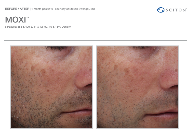 Before and after photos of a man's face, showing improvement after a Moxi laser treatment for pigmentation.