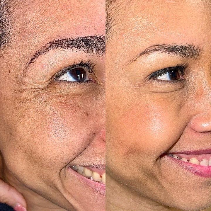 Side-by-side view of a smiling face. The left side displays wrinkles, while the right side appears smoother.