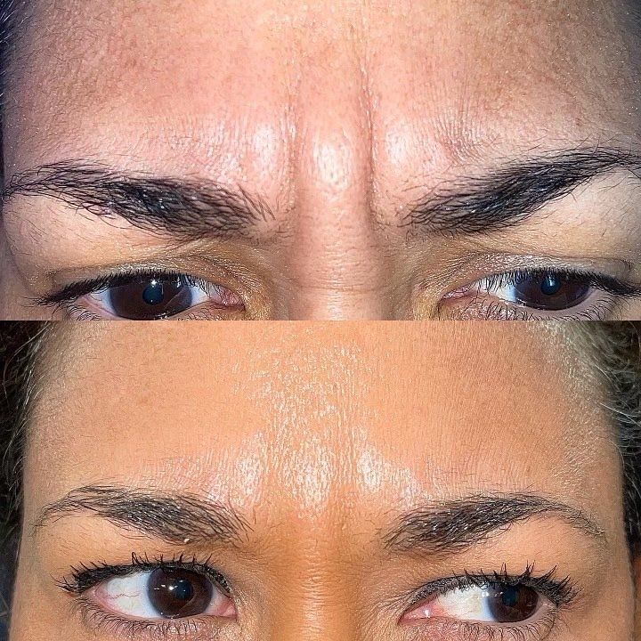 Top: Wrinkled forehead with furrowed brows. Bottom: Smooth forehead with relaxed brows, eyes looking right.