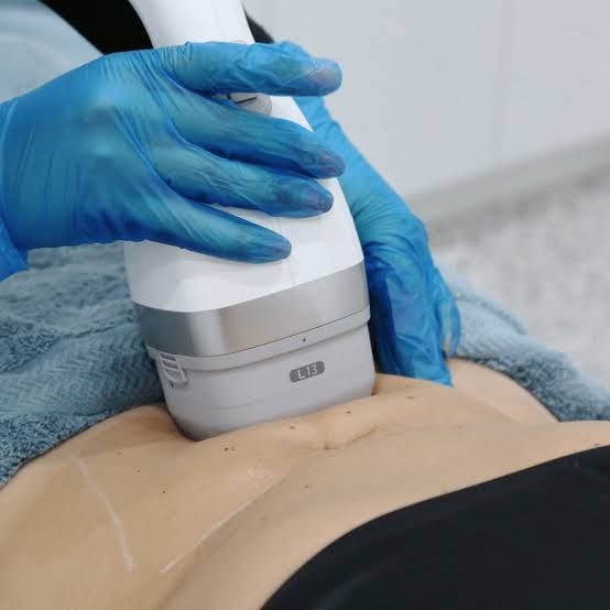 Provider using a LIPOcel HIFU applicator on a patient’s abdomen