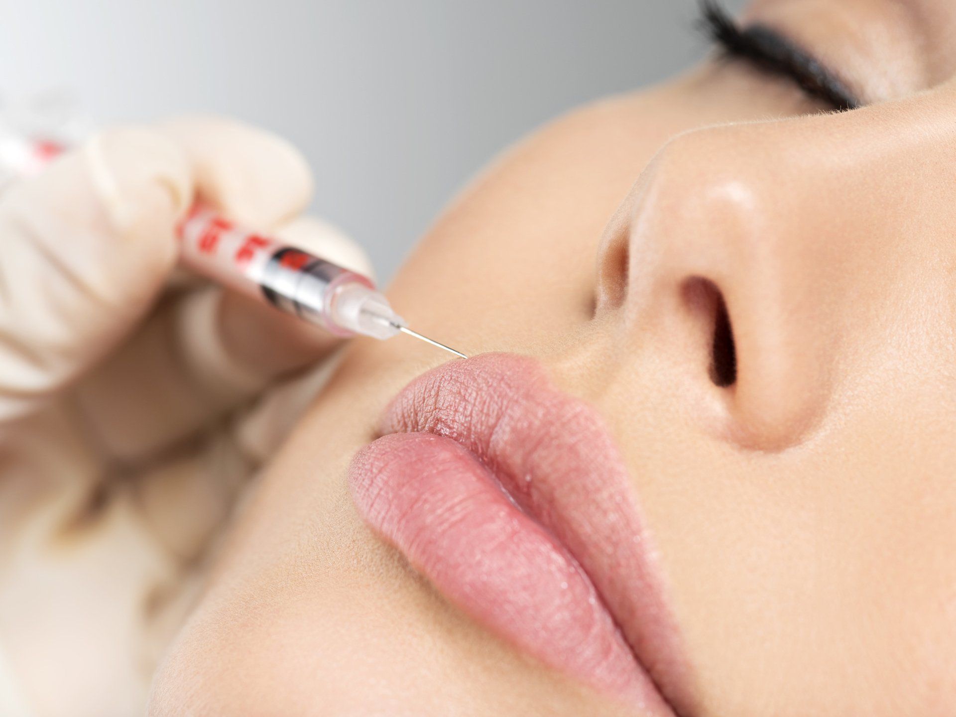 A person receiving a lip filler injection with a syringe. Close-up on lips.