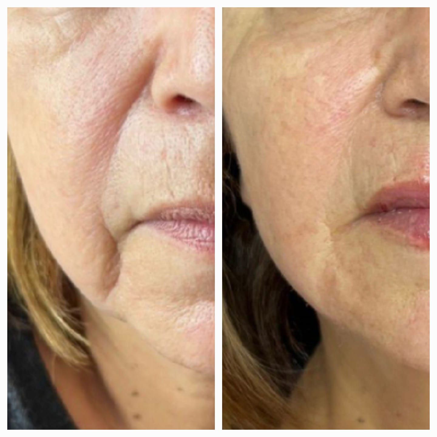 Primer plano comparativo de la parte inferior del rostro de una mujer, que muestra la textura de la piel y las arrugas.