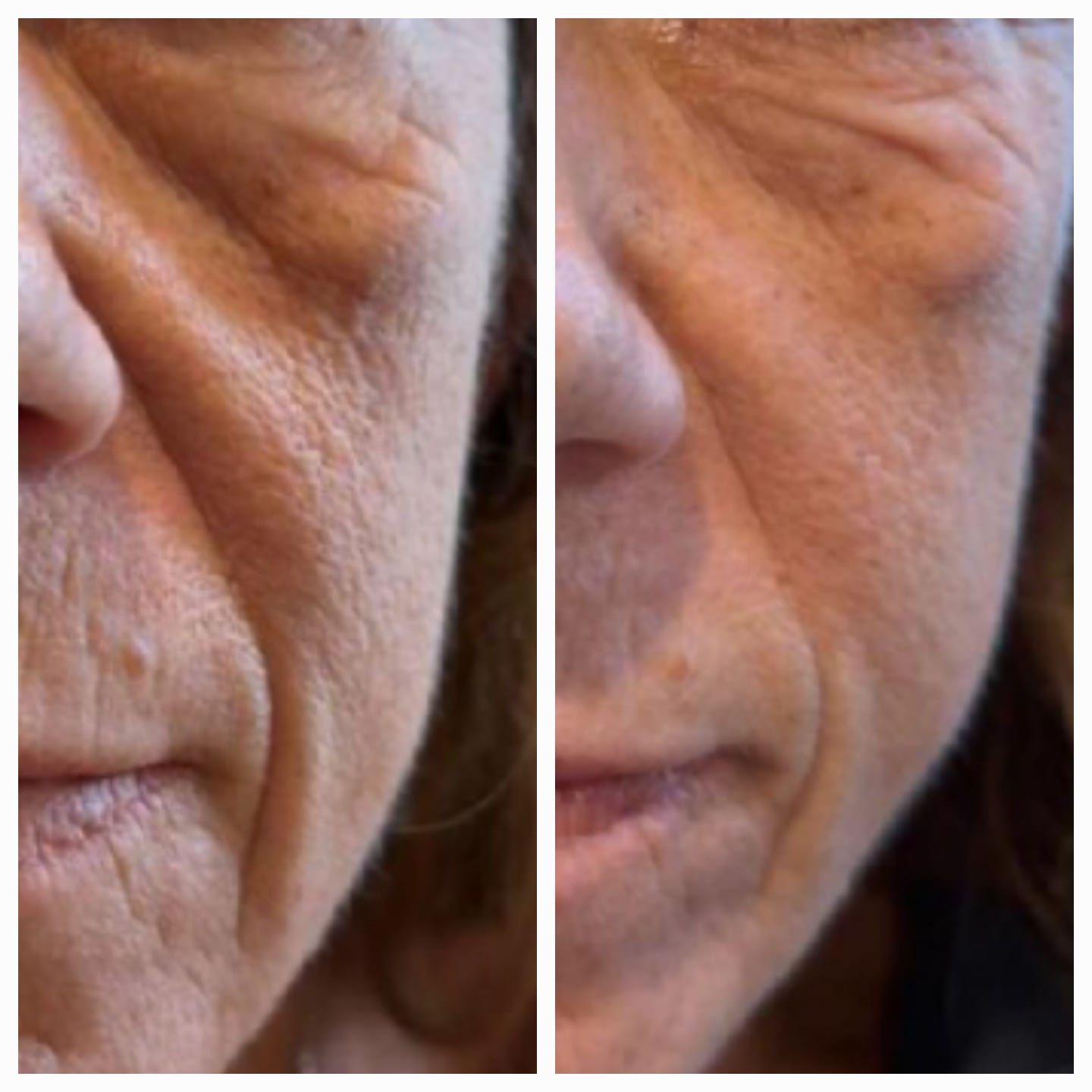 Primeros planos comparativos del mismo rostro que muestran las arrugas y la textura de la piel cerca del ojo y la mejilla.
