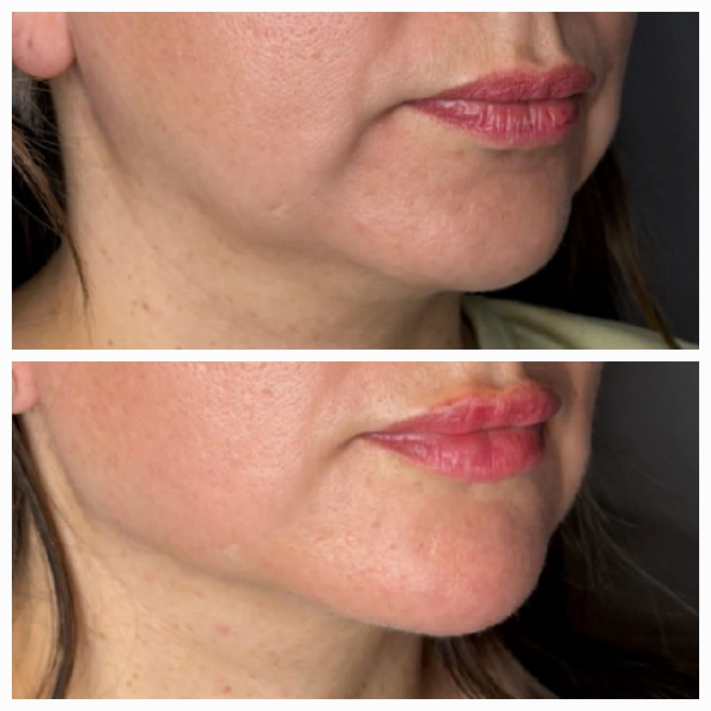 Primer plano comparativo de la parte inferior del rostro y la mandíbula de una mujer antes y después del tratamiento.
