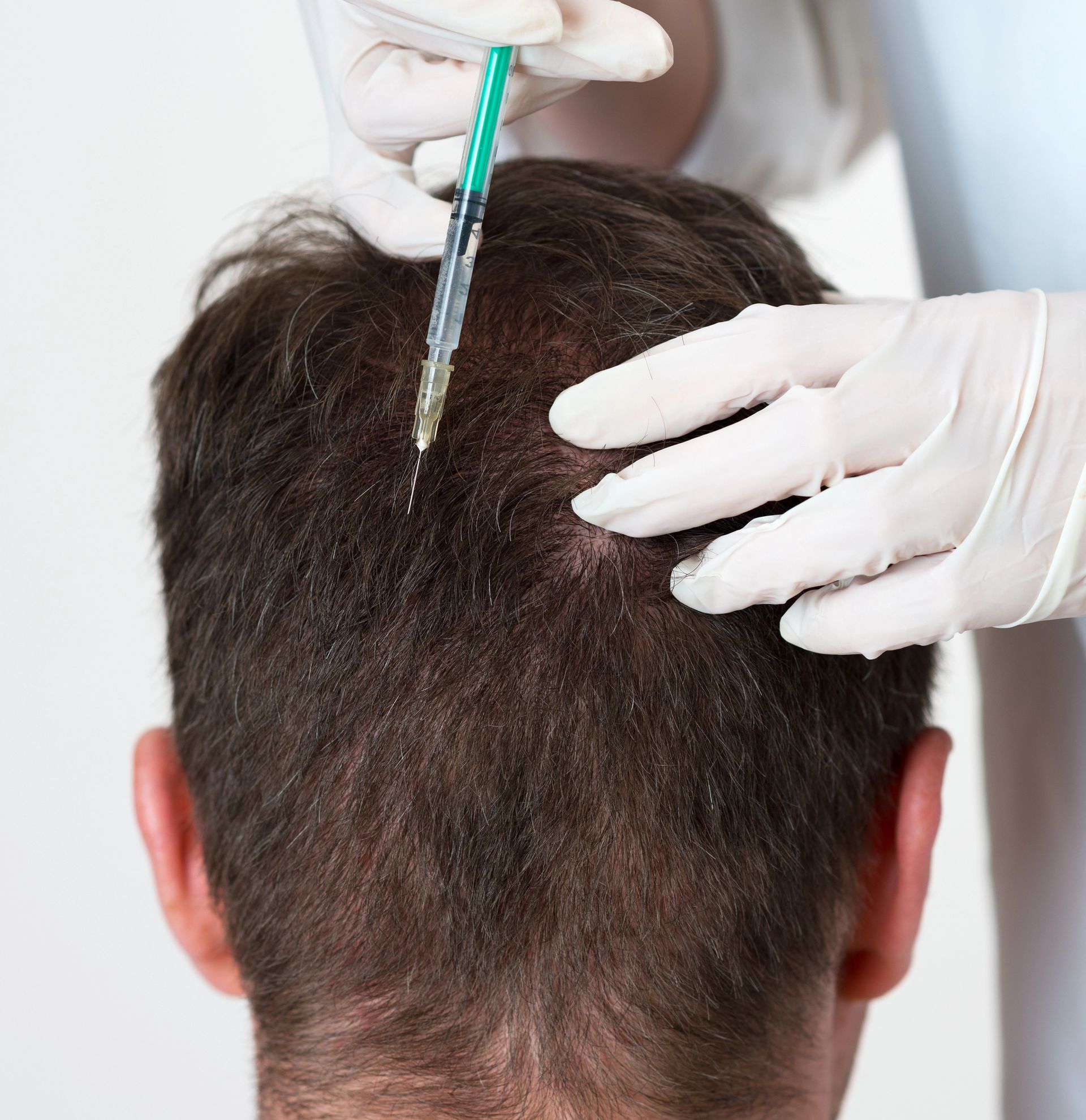 Manos enguantadas inyectando líquido en el cuero cabelludo de una persona con cabello castaño corto.