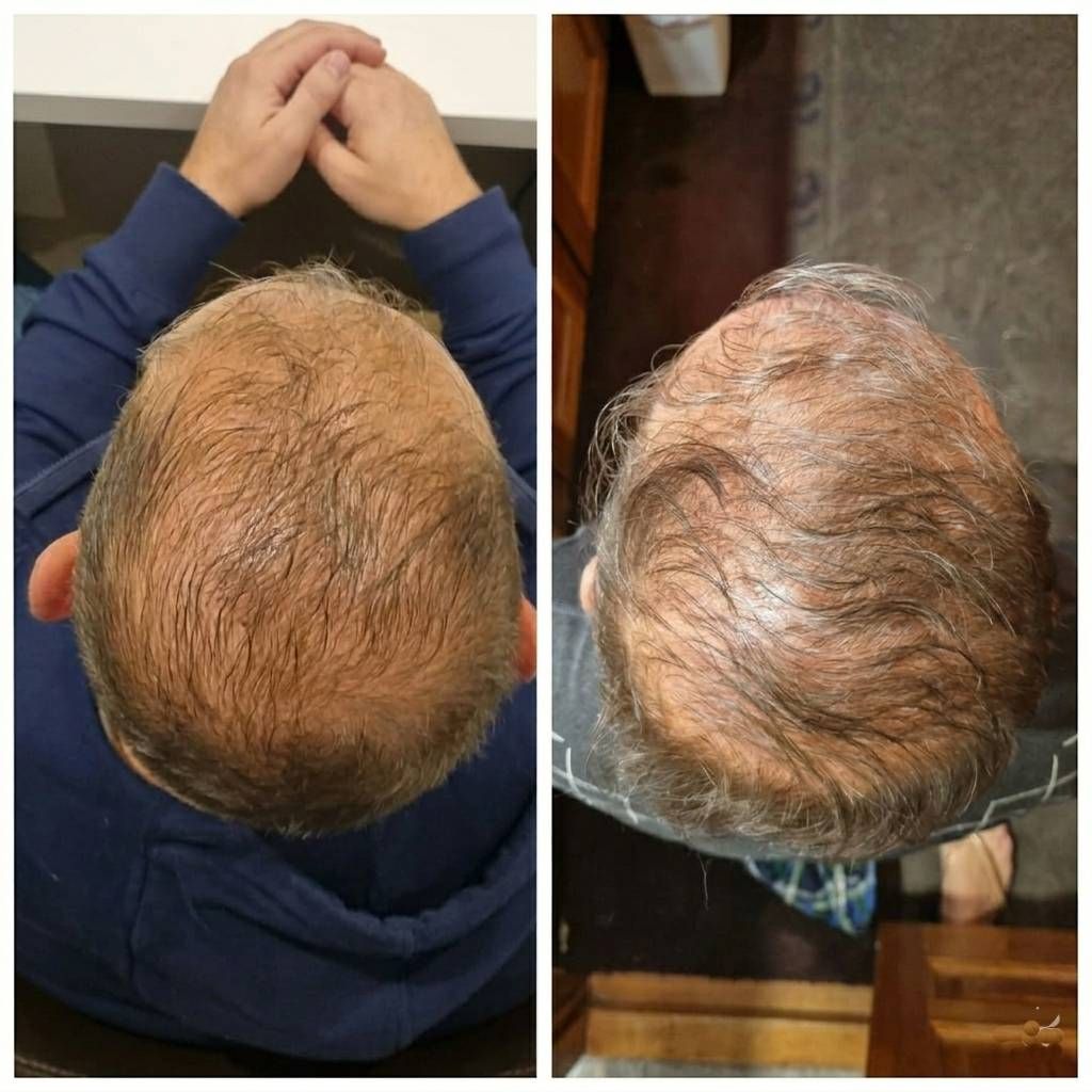 Fotos de antes y después tomadas desde arriba que muestran el adelgazamiento del cabello en la coronilla.