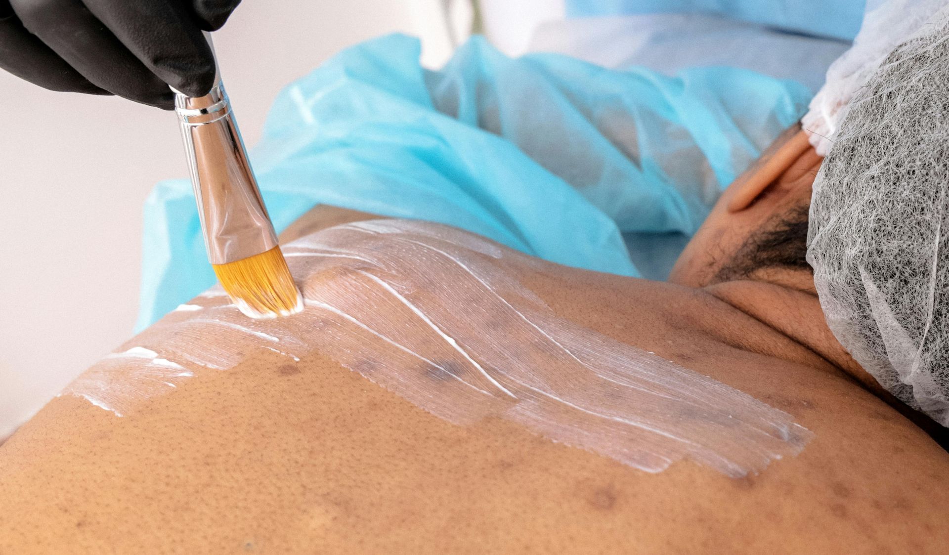 Durante un procedimiento médico, un profesional sanitario aplica gel transparente en la espalda del paciente con un pincel.