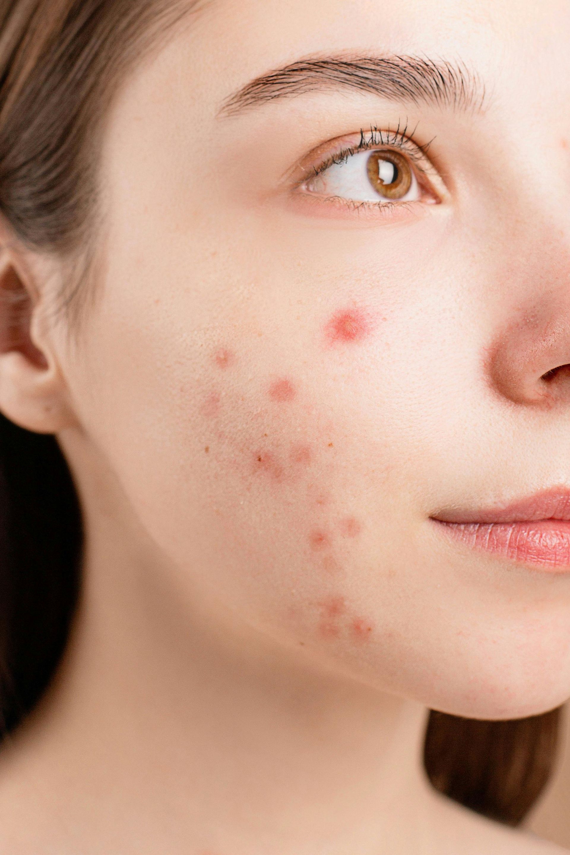 Primer plano de un rostro con manchas rojas de acné en la mejilla y la mandíbula.