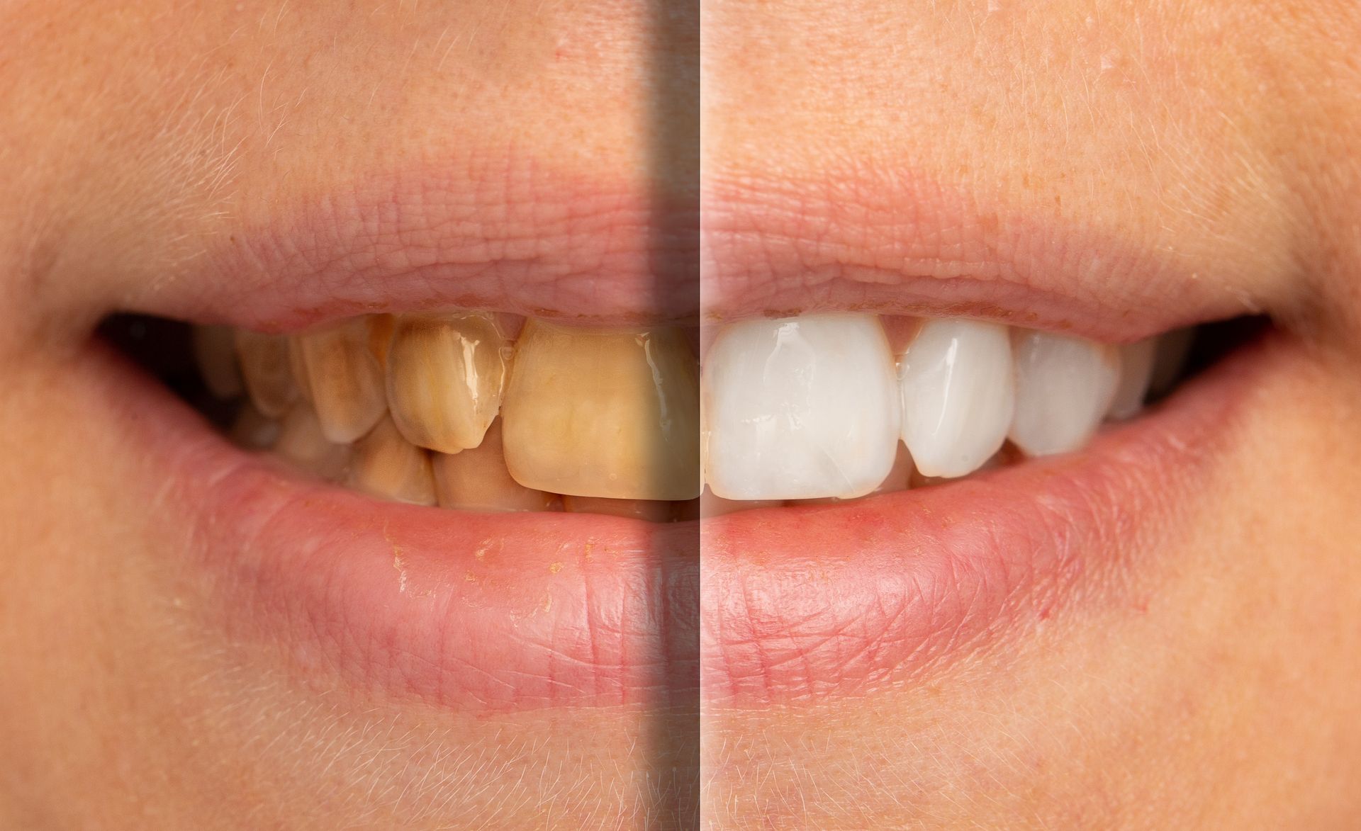 A before and after photo of a woman 's teeth.