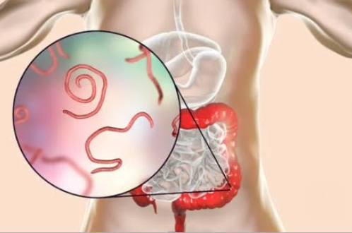 Diagram of human intestines with inset showing parasitic worms.