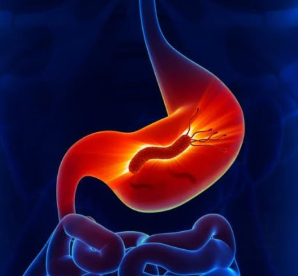 Illustration of a stomach infected by H. pylori bacteria, glowing red with intestines below.